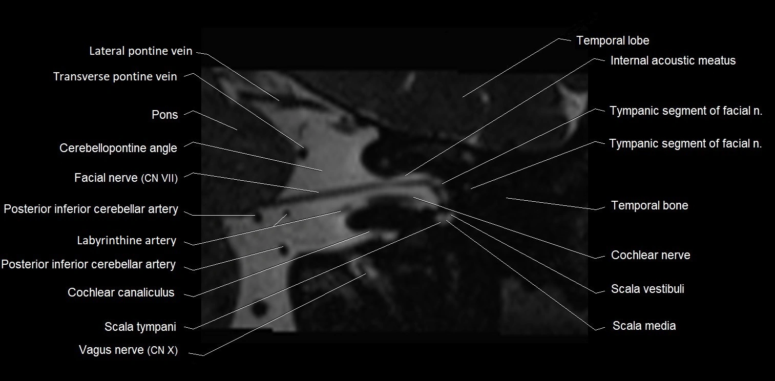 MRI Internal auditory meatus (IAM) coronal cross sectional labelled anatomy image 11.webp